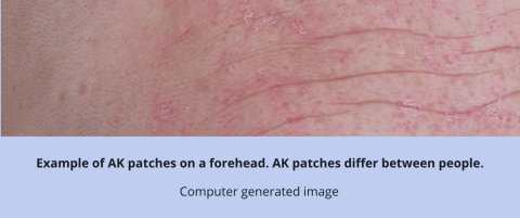 Example of AK patches on a forehead. AK patches differ between people.